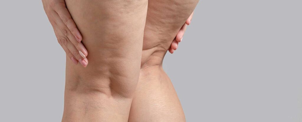 gambe con cellulite